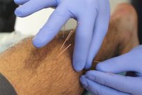 dryNeedling